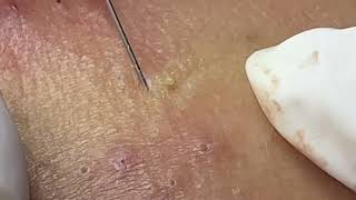 Acne treatment for Spa Linh Mun 2024 80 [upl. by Ahsiena]