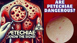 Identify and Treat Petechiae Spotting Serious Health Signals Fast [upl. by Daggett39]