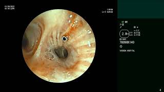 EBUS Needle Fracture  Bronchoscopic retrievel [upl. by Retsek]