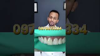 ✨ Direct Composite Veneers A Quick Smile Fix [upl. by Cacilie]