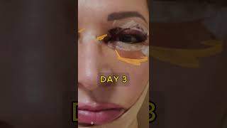 Facelift Recovery facelift plasticsurgery plasticsurgeon [upl. by Pergrim560]