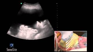 How To Ultrasound Guided Paracentesis Procedure 3D Video [upl. by Myrt375]