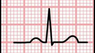 ECG Interpretation  Time and the ECG Section 1 Part 5 [upl. by Ettinger334]