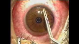 Lasik Laser Eye Surgery Procedure  Live Surgery [upl. by Kacey644]