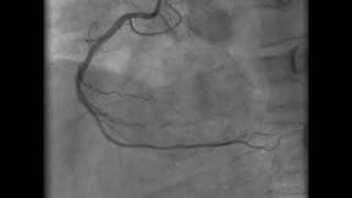 coronary angiogram [upl. by Maccarthy706]