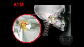 ATM Odontologia® Articulación Temporomandibular [upl. by Christoforo611]