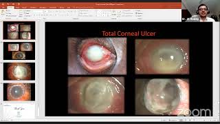 Fungal Corneal Ulcer Learn from the Masters  Sankara Academy of Vision [upl. by Eybba912]