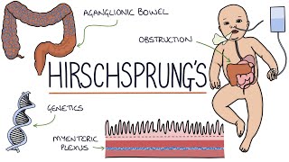 Hirschsprungs Disease [upl. by Ihsoyim]