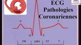 Interprétation de LÉlectrocardiogramme ischémie et infarctus du myocarde [upl. by Tyre275]