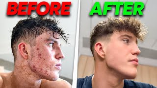 How I Cleared My Acne [upl. by Rolo834]