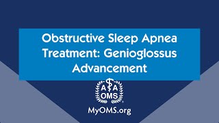 Obstructive Sleep Apnea Treatment Genioglossus Advancement [upl. by Sobmalarah]