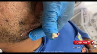 blackheads extractions blackheads and whiteheads removal blackheads new this week [upl. by Nugent]