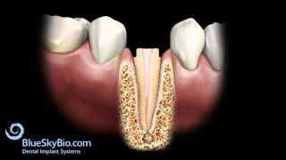 Patient Treatment Videos Root Canal [upl. by Elokkin]