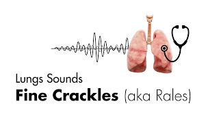 Fine Crackles Rales  Lung Sounds  MEDZCOOL [upl. by Scuram]