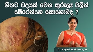 කුරුලෑ වදයෙන් බේරෙන්නෙ කොහොමද   Pimple Treatment Sinhala  Dr Nayani Madarasinghe [upl. by Miquela]