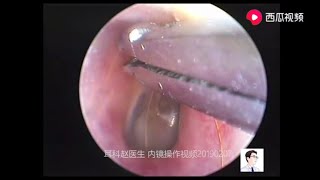 Treatment of foreign bodies cerumen and fungi on tympanic membrane surface for 11 minutes [upl. by Stein]