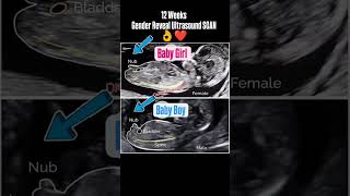 12 Weeks Gender Reveal Ultrasound Scan genderpredictions genderdetermination genderreveal [upl. by Fara]