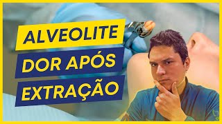 ALVEOLITE  O QUE CAUSA COMO TRATAR [upl. by Ortrud]