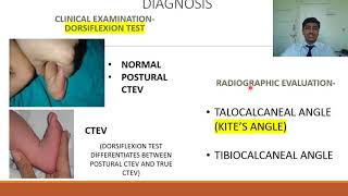 Congenital Talipes Equino Varus CTEV  Rapid Revision of Orthopaedics by Dr Prateek Joshi [upl. by Fidelio]