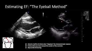 POCUS for Ejection Fraction [upl. by Maiocco172]