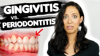 Do You Have Gingivitis or Periodontitis  Different Stages Of Gum Disease [upl. by Tsiuqram]