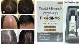 Fixodil M5 Hair Solution ALCOHOL FREE Minoxidil amp FinasterideTopical Solution [upl. by Mages]