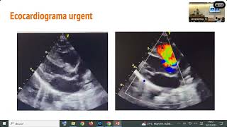 Sessió Grup de Treball de Cardiologia 16102023 Casos clínics peculiars [upl. by Annavoj]