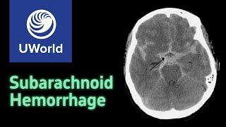 Subarachnoid Hemorrhage amp Treatment  nimodipine USMLE STEP 1 UWORLD Questions Nervous system [upl. by Charry]