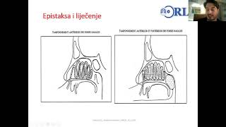 Predavanje Hitna stanja u ORL [upl. by Hook]