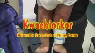 Kwashiorkor [upl. by Intosh]