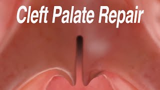 Cleft Palate Repair Furlow Palatoplasty Technique [upl. by Gabey]