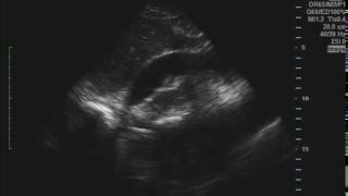 Cardiac Tamponade Ultrasound JETem 2016 [upl. by Aicilanna486]