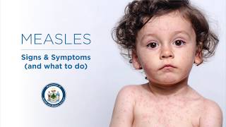 Measles Signs and Symptoms [upl. by Batholomew]