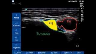 US guided femoral nerve block [upl. by Onaled664]