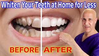 Whiten Your Teeth at Home for Nearly Free Dr Mandell [upl. by Nahtaneoj]