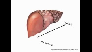 Minivideo What is cirrhosis [upl. by Enitnatsnoc800]