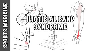 Iliotibial Band Syndrome ITBS  Overview [upl. by Iznyl]