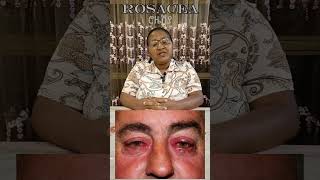 Rosacea ሮዜሽያ [upl. by Anse]