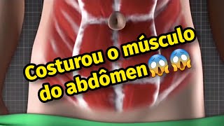 ABDOMINOPLASTIA  quotcosturaquot o músculo e quotesticaquot pele do abdomen [upl. by Jolanta]