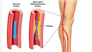 Claudication in legs  treatment  exercise  claudication Pathophysiology [upl. by Atnamas]