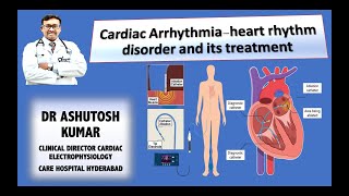 ARRHYTHMIA EP STUDY AND RF ABLATIONDR ASHUTOSH KUMAR MD DM FACC FHRS [upl. by Neelyak]