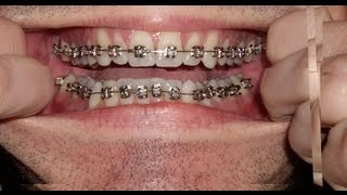 Braces  Photo taken every day  Before and After Transformation  Orthodontics Timelapse [upl. by Kin325]