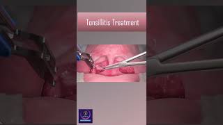 Tonsillitis Treatment With Heat Device tonsillitis [upl. by Bernadette]