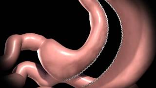 Realize Sleeve Gastrectomy Procedure Animation [upl. by Suoicul92]