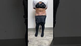 1 DAY AFTER A TUMMY TUCK BY DR GABRIEL PATINO 05 09 20245105257999 [upl. by Burrton869]