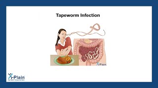 Tapeworm Infection [upl. by Kelvin]