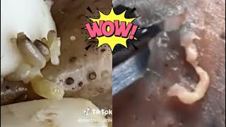 Ultimate Pimple Popping Compilation  Extreme Acne Treatment  Satisfying Blackhead Removal [upl. by Lennej]