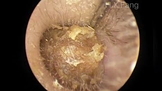 Easy earwax removal简单的耳屎清理20230903 [upl. by Farika783]