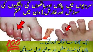 Feet Swelling Treatment Paon ki Sojan Ka ilaj  Chilblains treatment at home  Home Remedies [upl. by Krista]