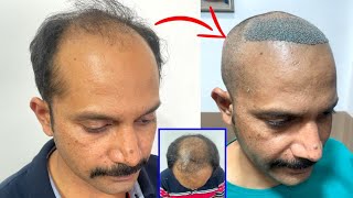 new technology Hair Transplant  Best Hair Transplant Surgery  Before after Hair Transplant [upl. by Atsirt]